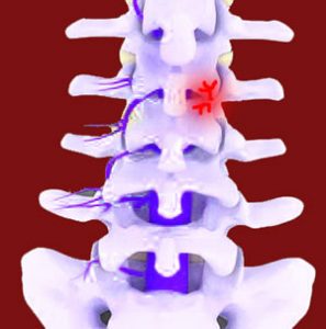 Facet Joint Injury Facet Joint Pain